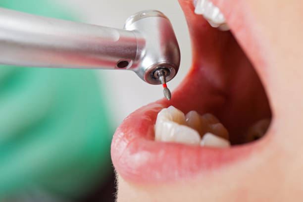 Best Emergency Dental Care for Broken or Chipped Teeth in Sanger, CA